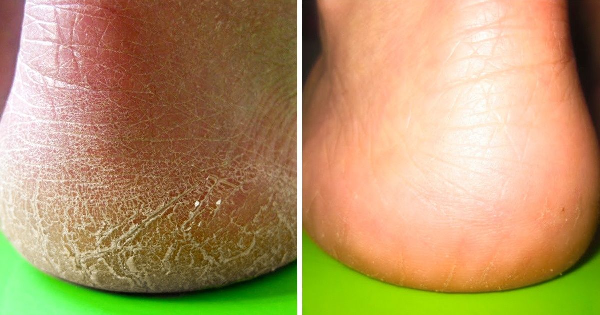 10 Manières rapides pour te débarrasser des cors et faire que tes pieds soient aussi doux que ceux d’un bébé