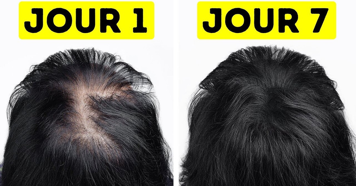 Je Suis Passée de Cheveux Fins à épais en Une Semaine Seulement