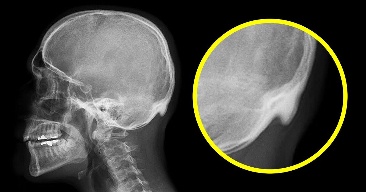Les scientifiques ont découvert que nos gadgets ont déjà réussi à affecter la structure de notre squelette Les scientifiques ont découvert que nos gadgets ont déjà réussi à affecter la structure de notre squelette