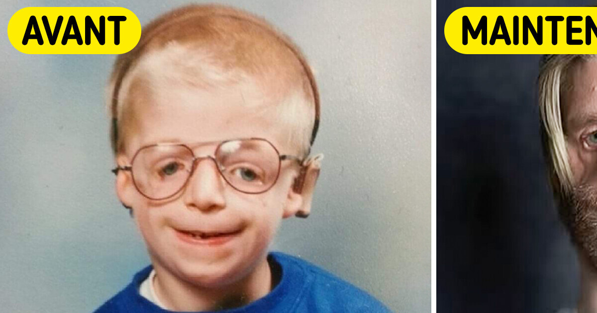 Abandonné par ses parents en raison de son apparence, il est devenu une véritable source d’inspiration Abandonné par ses parents en raison de son apparence, il est devenu une véritable source d’inspiration