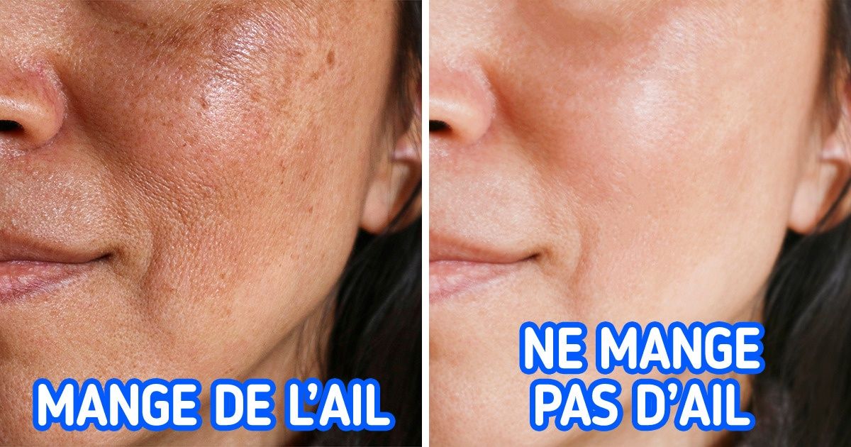 Les causes de la pigmentation de la peau et 4 façons de l’éviter