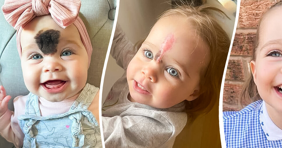 Ces parents font retirer la tache de naissance rare de leur fille pour lui éviter les regards insistants Ces parents font retirer la tache de naissance rare de leur fille pour lui éviter les regards insistants