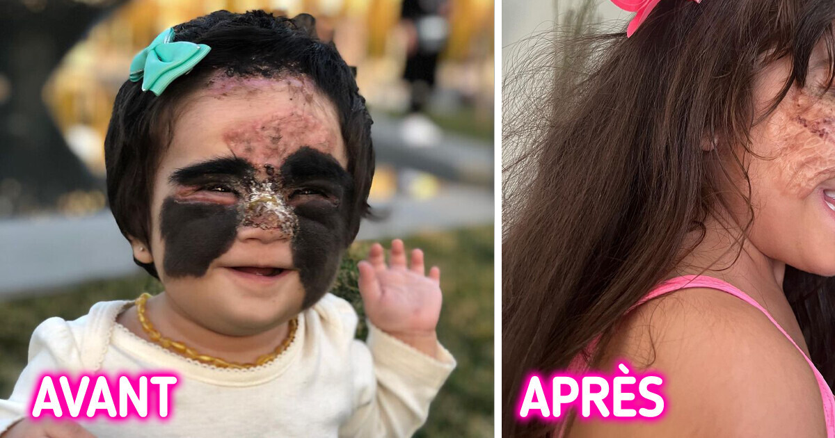 Cette petite fille était traitée de “monstre”, maintenant elle ressemble à une princesse de Disney Cette petite fille était traitée de “monstre”, maintenant elle ressemble à une princesse de Disney