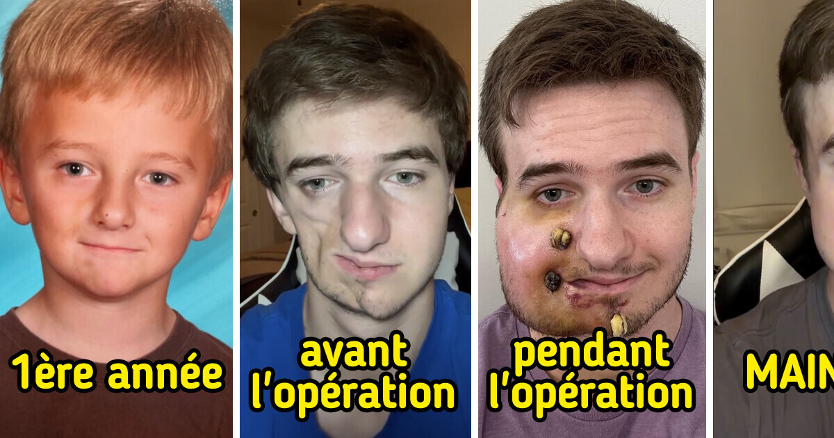 Voici Lukas : la véritable histoire du syndrome de Parry-Romberg et son apparence actuelle Voici Lukas : la véritable histoire du syndrome de Parry-Romberg et son apparence actuelle