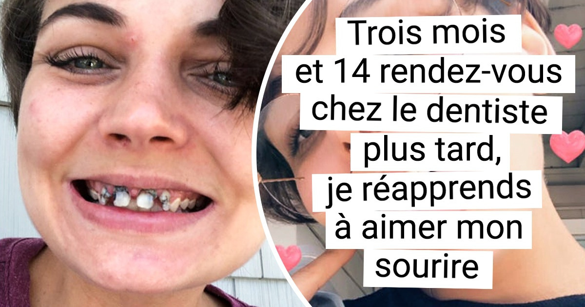 15+ Personnes qui ont osé changer leur sourire et ont la banane depuis