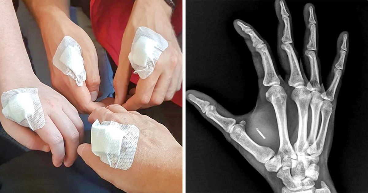 Les Suédois implantent massivement des puces dans leurs mains et ça fait froid dans le dos Les Suédois implantent massivement des puces dans leurs mains et ça fait froid dans le dos