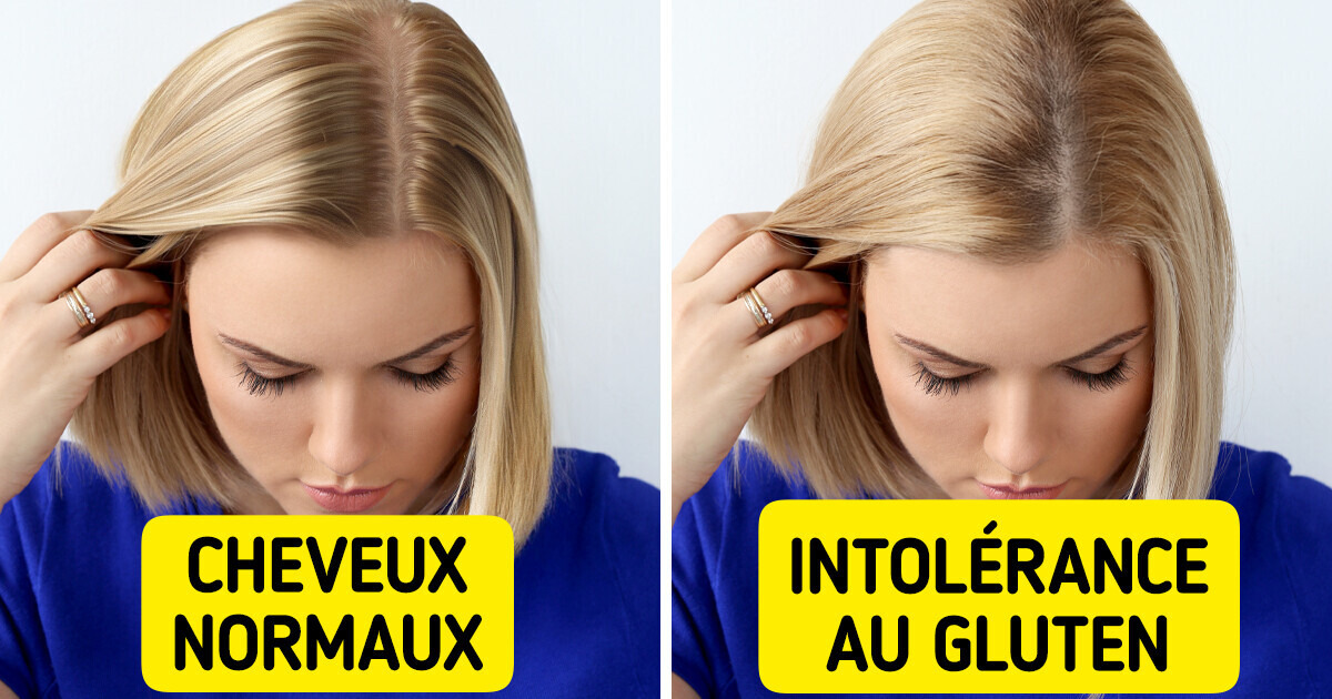 11 Signes inhabituels qui pourraient indiquer que tu as une intolérance au gluten 11 Signes inhabituels qui pourraient indiquer que tu as une intolérance au gluten
