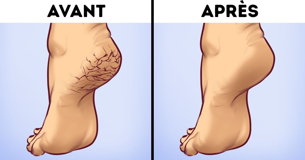 Grâce aux conseils de ce podologue, j’ai réussi à éliminer les durillons et mes crevasses sur les pieds avec des solutions “maison” Grâce aux conseils de ce podologue, j’ai réussi à éliminer les durillons et mes crevasses sur les pieds avec des solutions “maison”