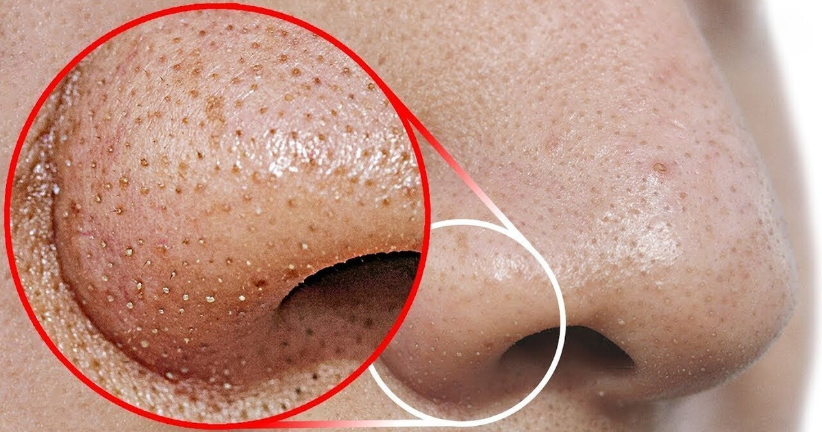 Voici ce Que tu Dois Faire Pour te Débarrasser Des Points Noirs du Nez