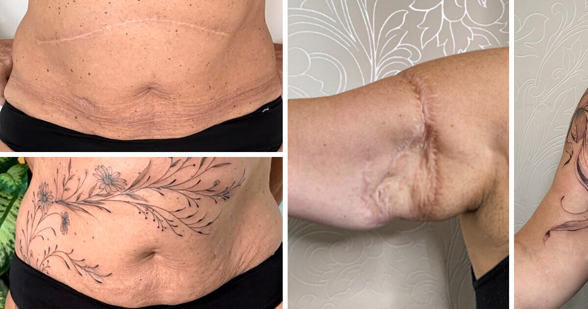 Cette artiste redéfinit les cicatrices comme des symboles de force et de beauté Cette artiste redéfinit les cicatrices comme des symboles de force et de beauté