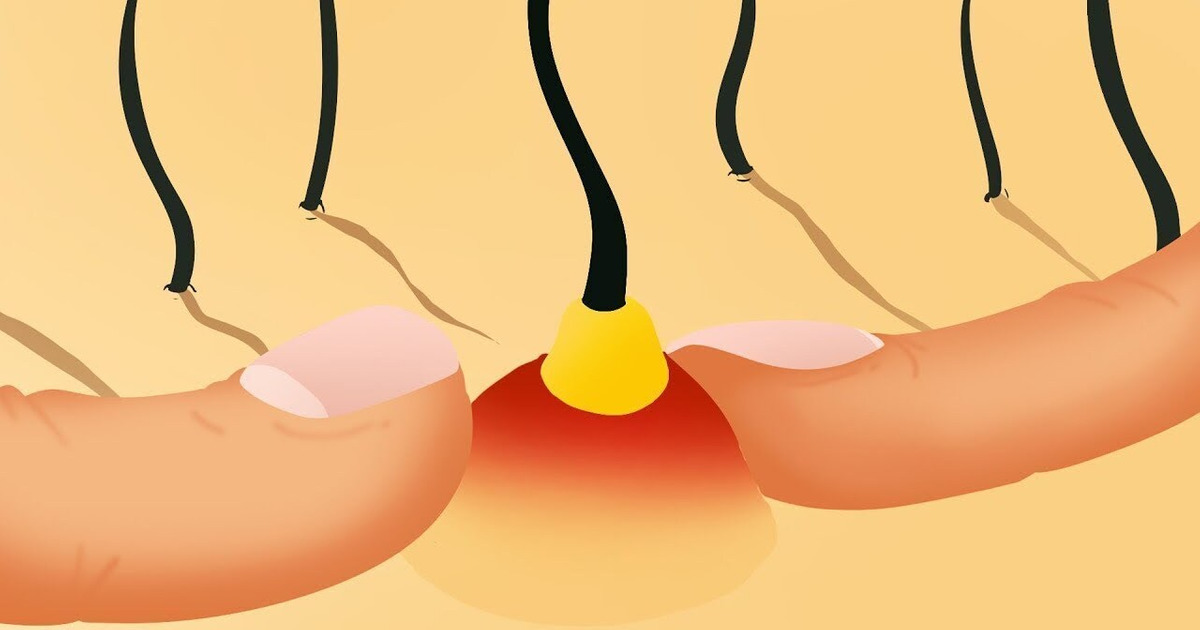 De Quoi Est Composé un Bouton ? Ne L’explose Jamais ! De Quoi Est Composé un Bouton ? Ne L’explose Jamais !