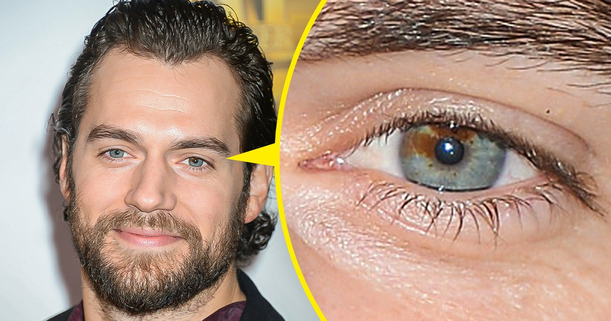 9 Célébrités qui présentent fièrement leurs soi-disant "imperfections" 9 Célébrités qui présentent fièrement leurs soi-disant "imperfections"