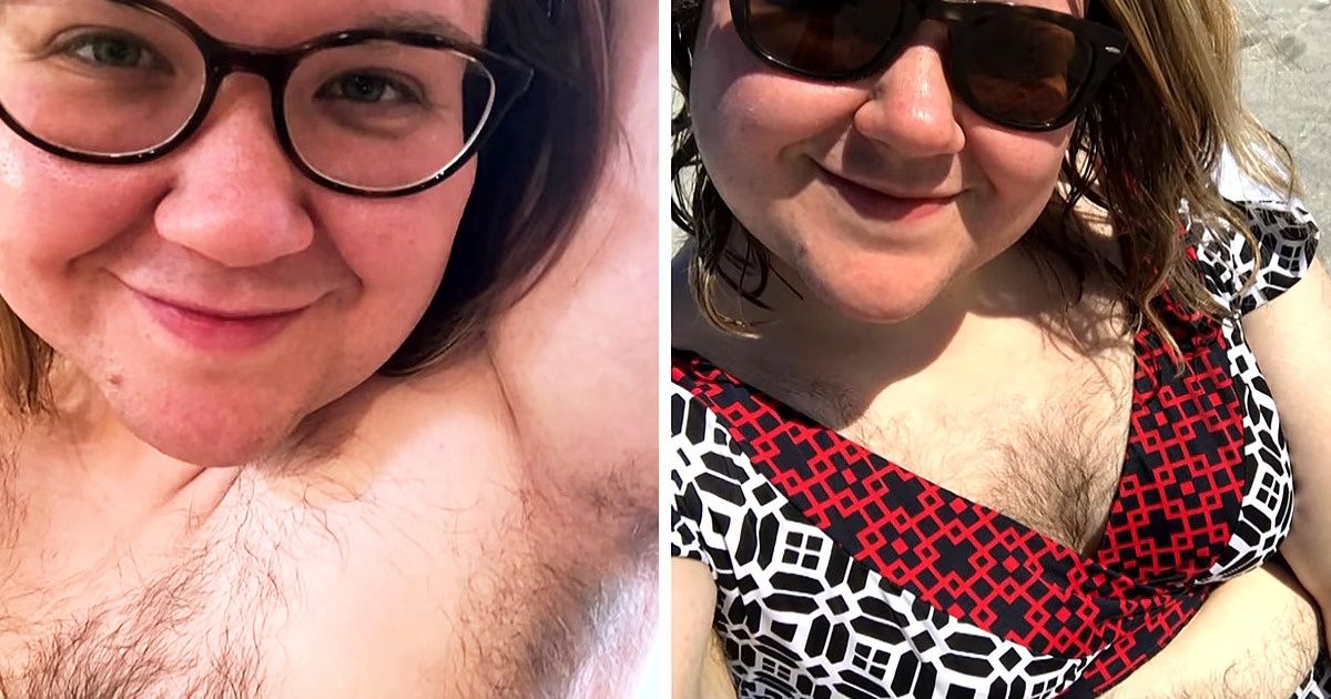 Une femme atteinte du syndrome des ovaires polykystiques a appris à aimer ses poils