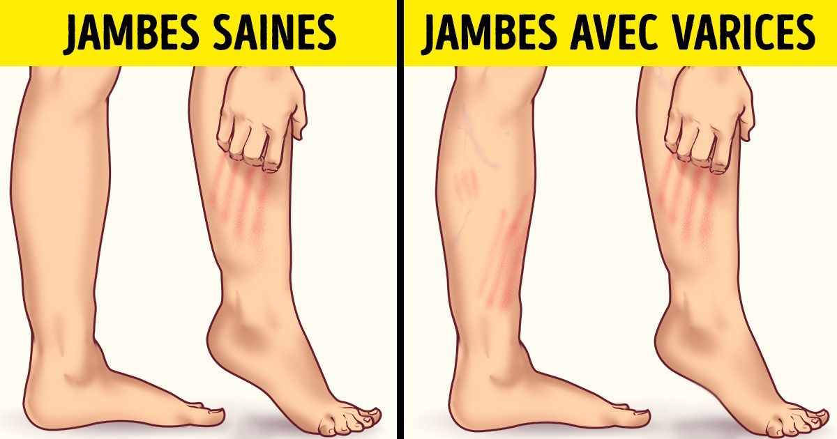 varices jambes que faire)