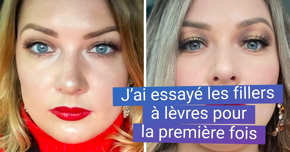 16 Jeunes femmes ont montré comment les injections ont transformé leur visage