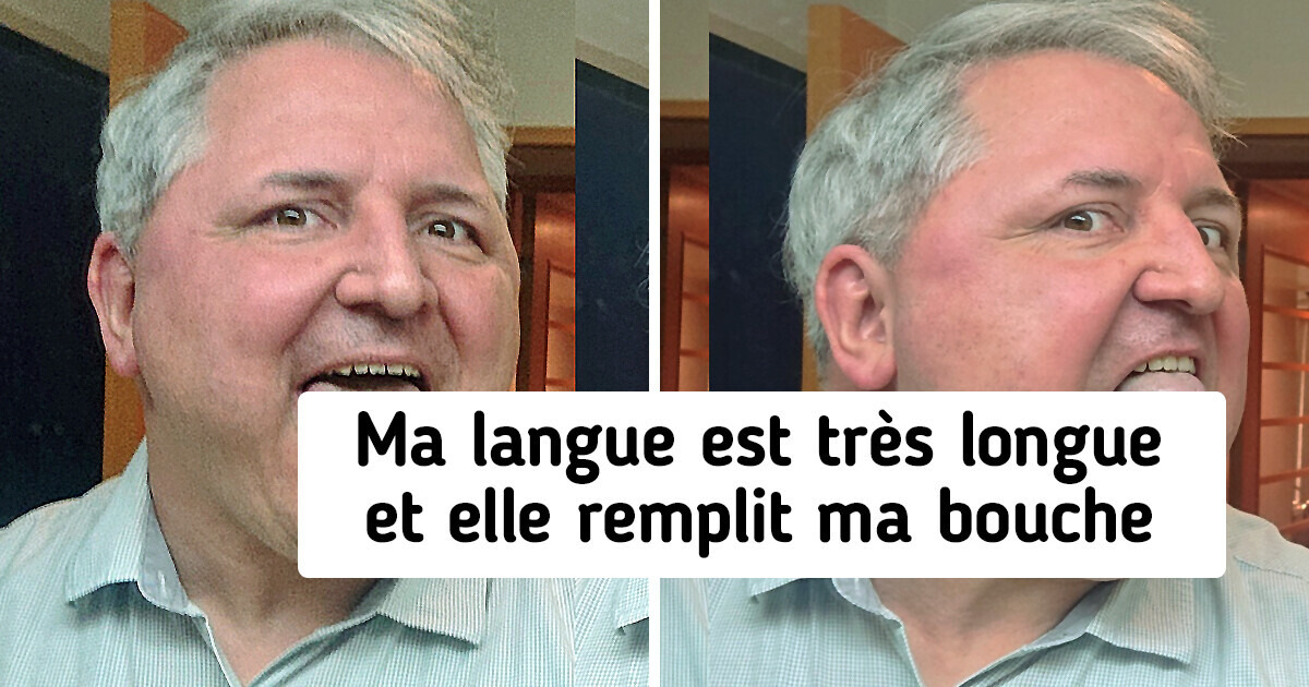 20+ Personnes qui sont nées avec des traits uniques