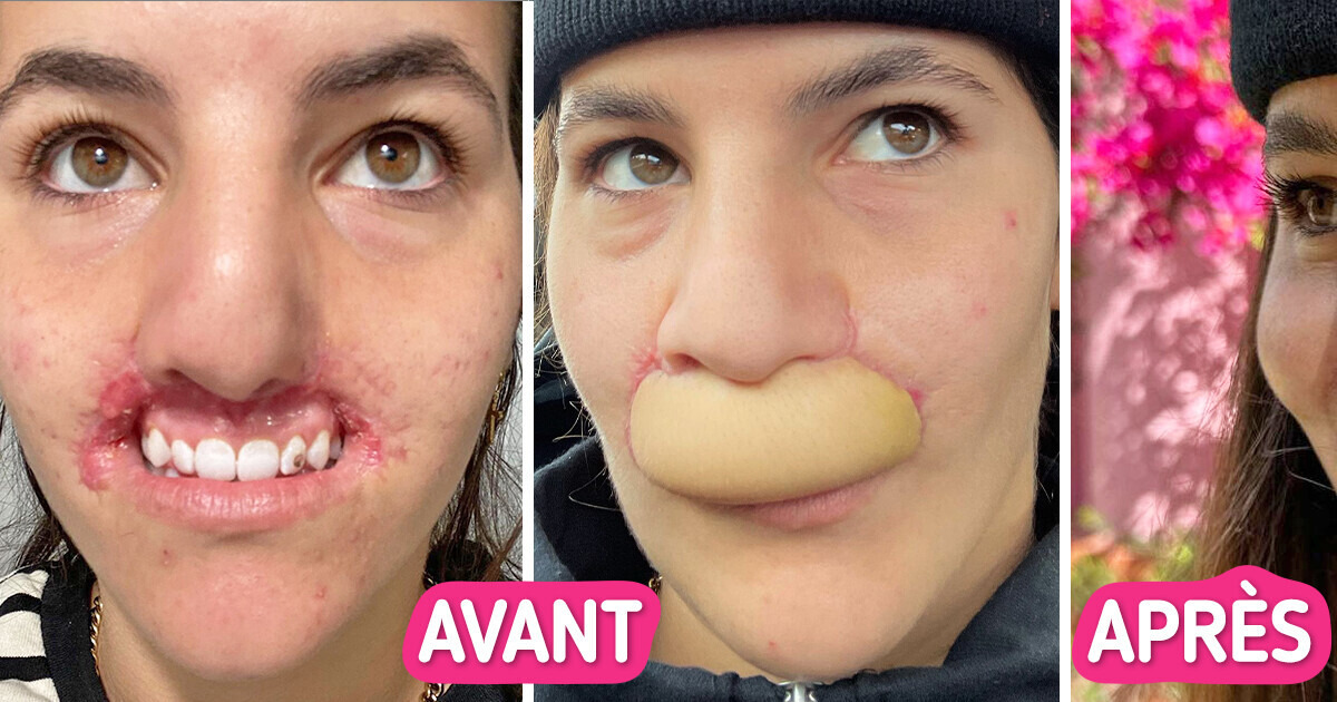 Attaquée par un Pitbull, ce mannequin a perdu ses lèvres et parle de sa guérison sur les réseaux sociaux Attaquée par un Pitbull, ce mannequin a perdu ses lèvres et parle de sa guérison sur les réseaux sociaux