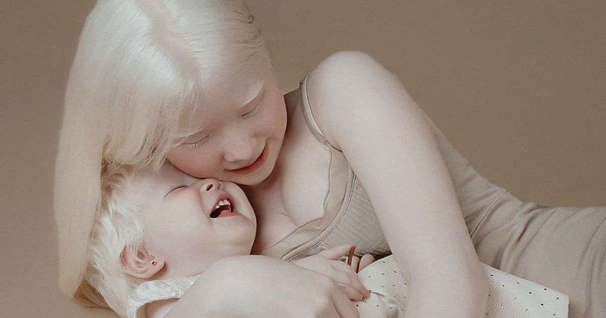 Deux sœurs albinos nées à 12 ans d’intervalle agitent la toile avec leurs photos