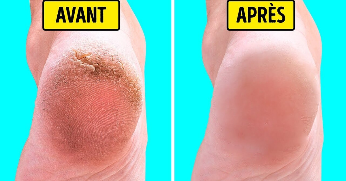 10 Remèdes Faits Maison Pour Avoir Des Pieds Doux et Soyeux