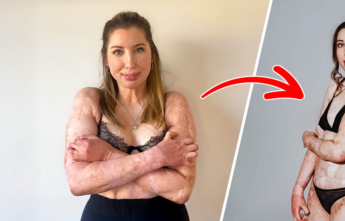 Une femme, brûlée vive à 96 %, rayonne aujourd’hui en bikini et défie les normes de beauté