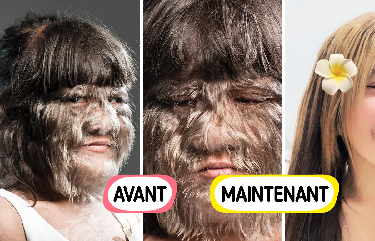 La célèbre “fille la plus poilue du monde” présente une transformation étonnante La célèbre “fille la plus poilue du monde” présente une transformation étonnante