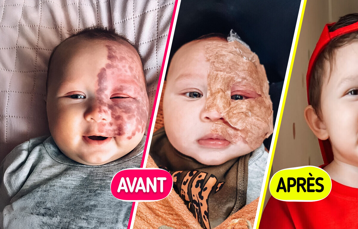 Une maman, traitée de “monstre” pour avoir fait enlever la tache de naissance de son bébé, brise le silence Une maman, traitée de “monstre” pour avoir fait enlever la tache de naissance de son bébé, brise le silence
