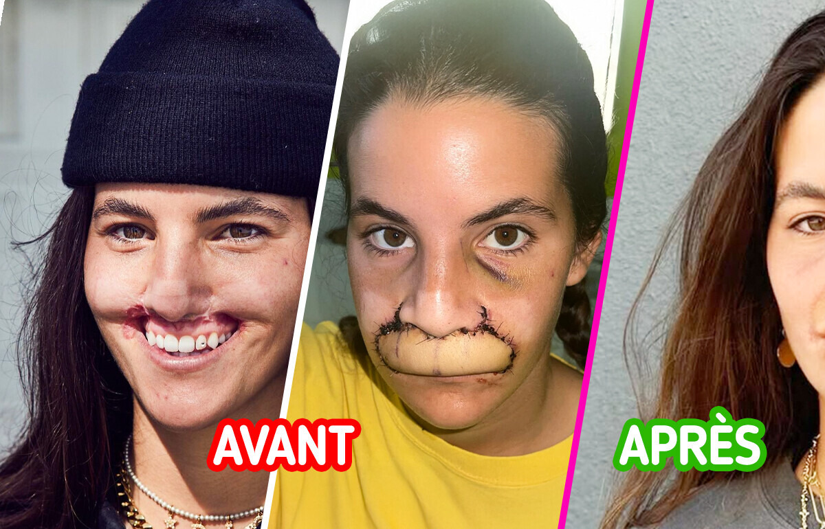 Une fille défigurée par un pitbull révèle son incroyable combat pour retrouver une vie normale Une fille défigurée par un pitbull révèle son incroyable combat pour retrouver une vie normale