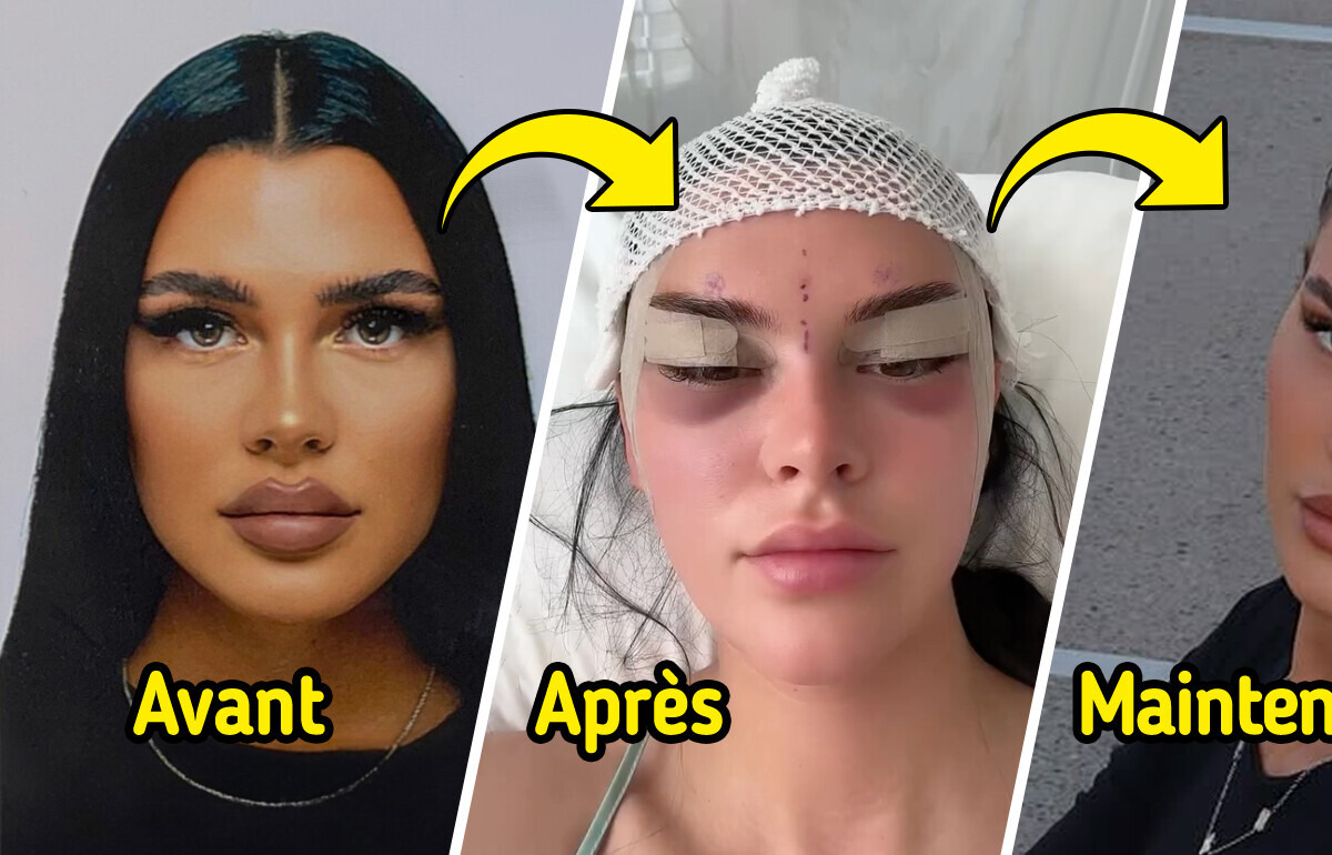 Une jeune femme partage son expérience de la chirurgie des yeux de renard