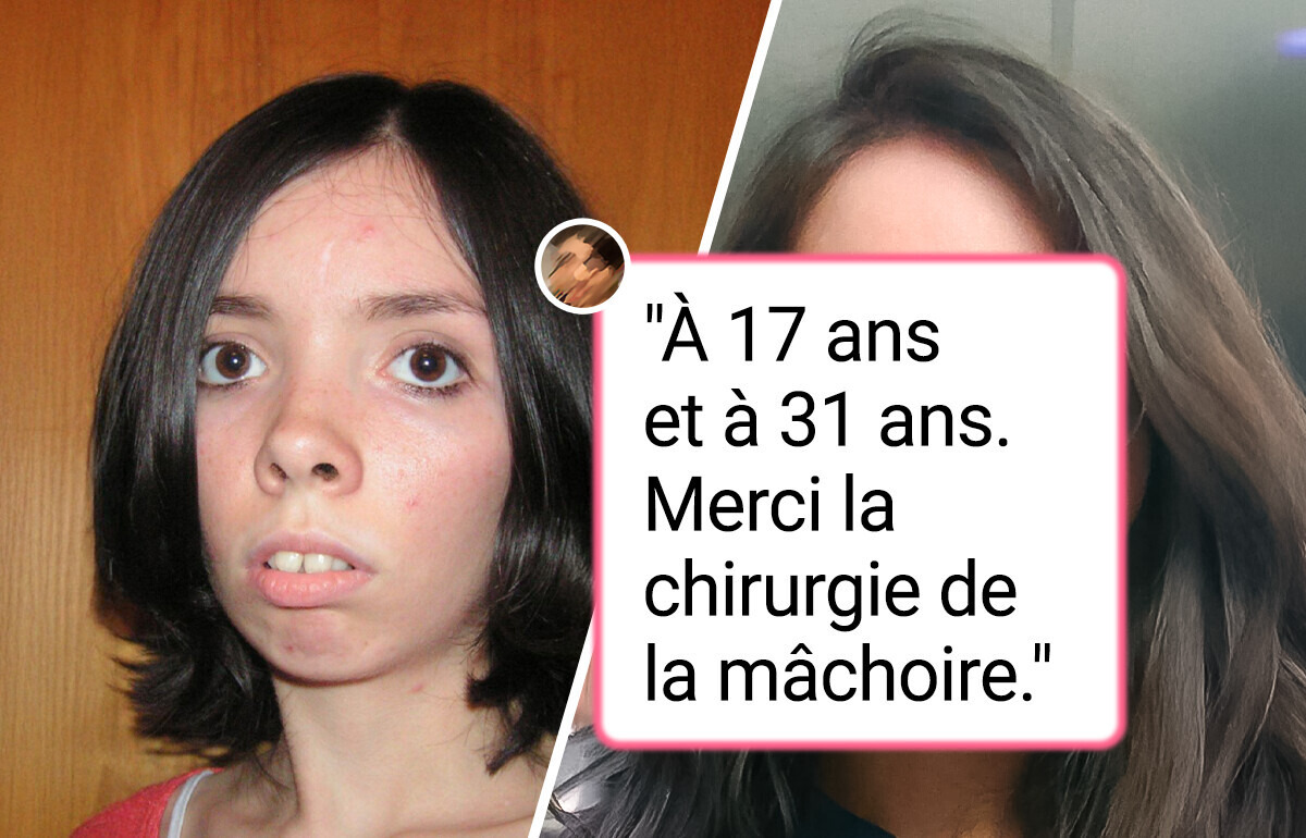 18 Personnes qui ont obtenu des résultats étonnants grâce à la chirurgie esthétique