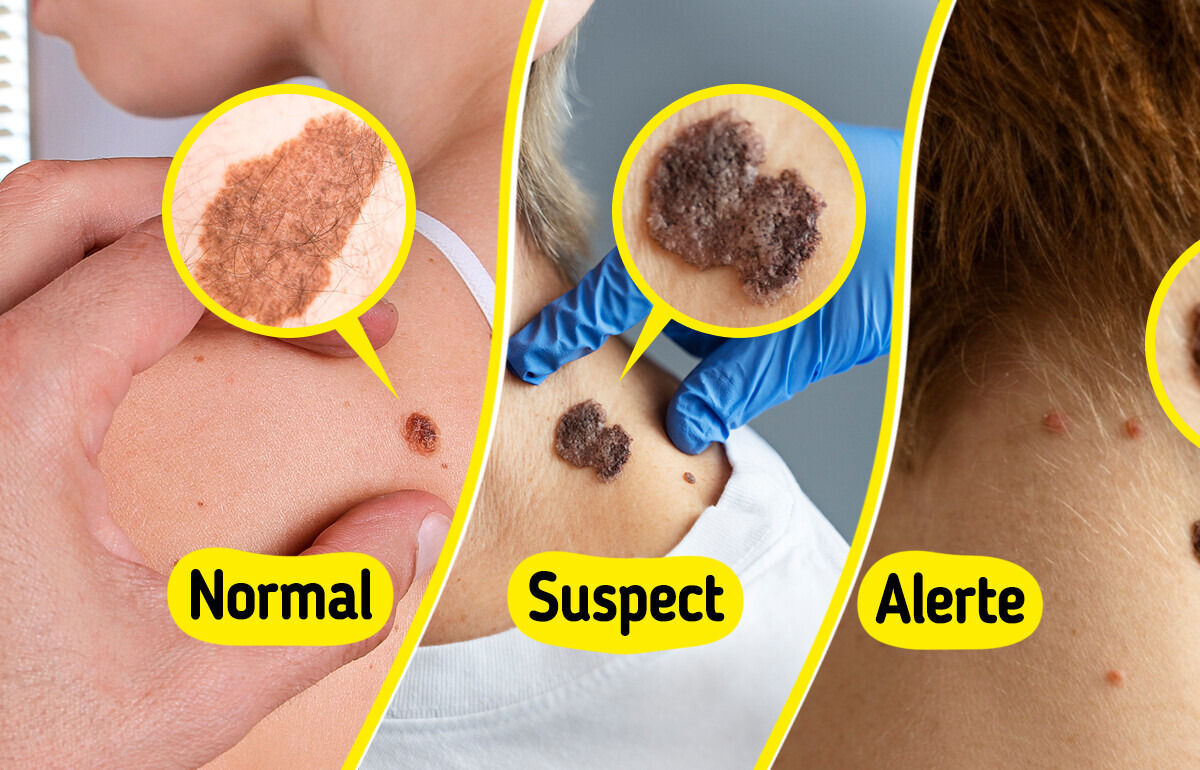 5 Signes indiquant que ton grain de beauté pourrait être dangereux 5 Signes indiquant que ton grain de beauté pourrait être dangereux