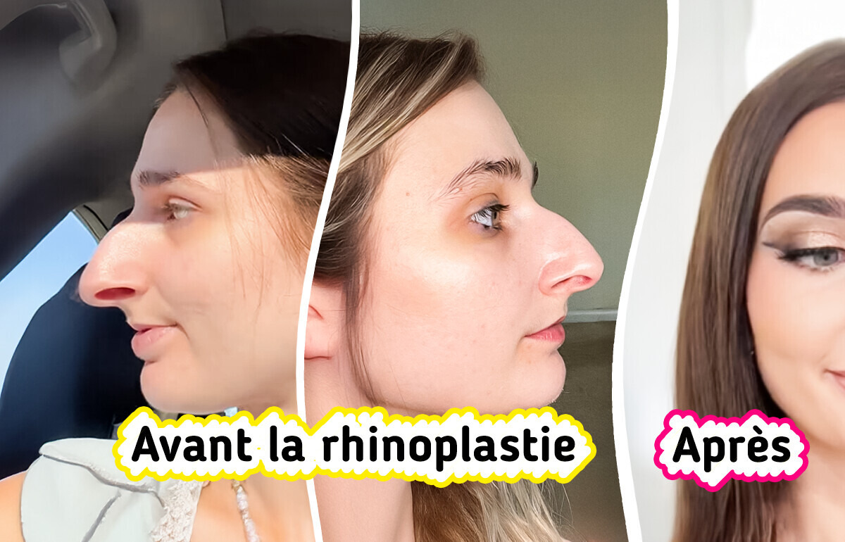 Une femme a passé dix ans à économiser pour une rhinoplastie, et le résultat divise la toile