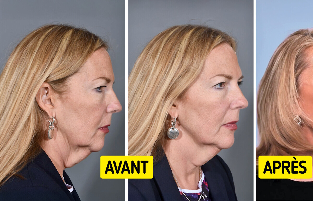 "Elle paraît 20 ans plus jeune", une femme subit une transformation bluffante après une opération "Elle paraît 20 ans plus jeune", une femme subit une transformation bluffante après une opération