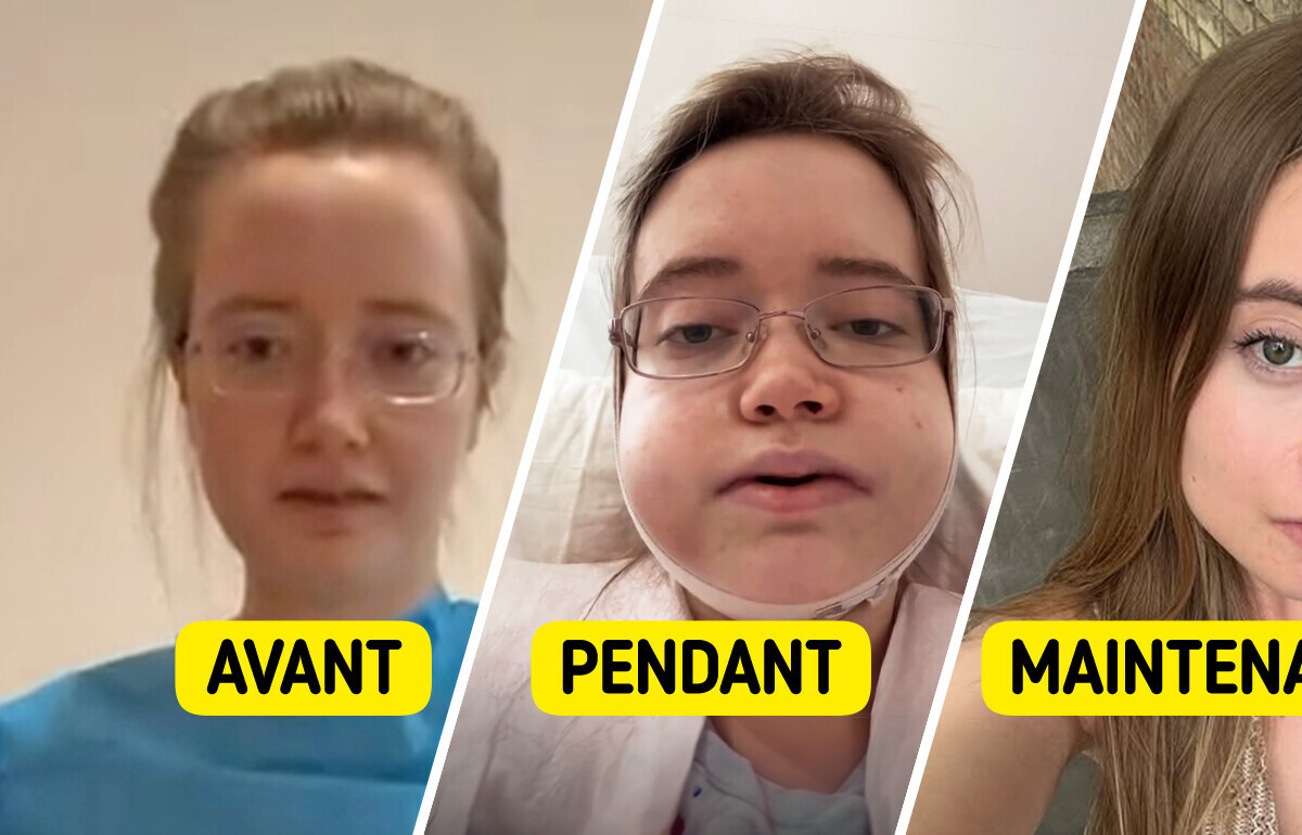 Elle voyage 24 heures pour se faire opérer de la mâchoire et le résultat choque les internautes