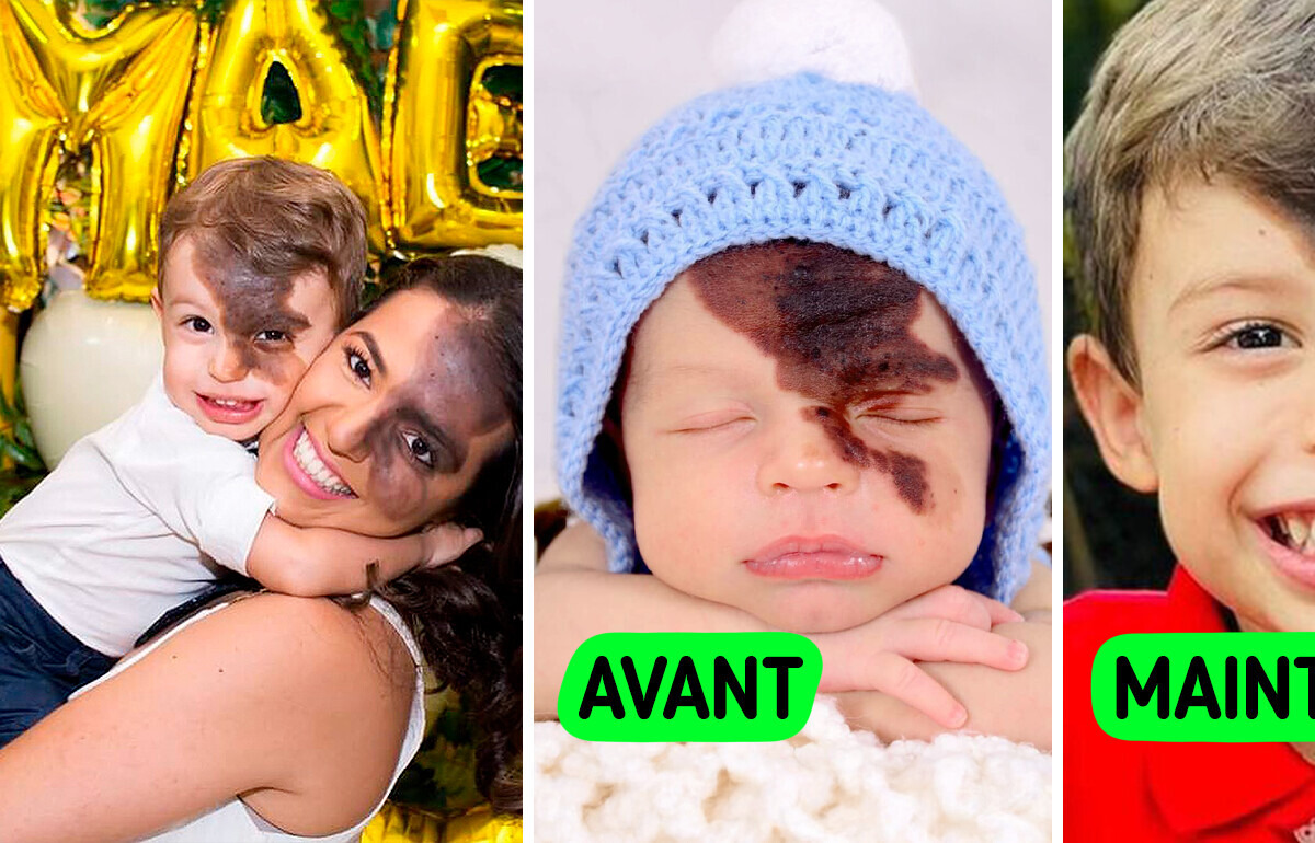 Une maman est prête à tout pour mettre son fils à l’aise et l’aider à accepter sa tache de naissance