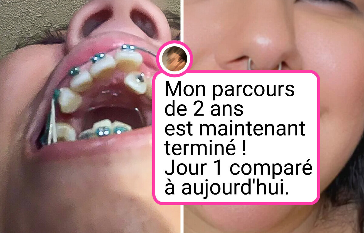 15 Personnes enchantées de partager l’évolution de leur sourire