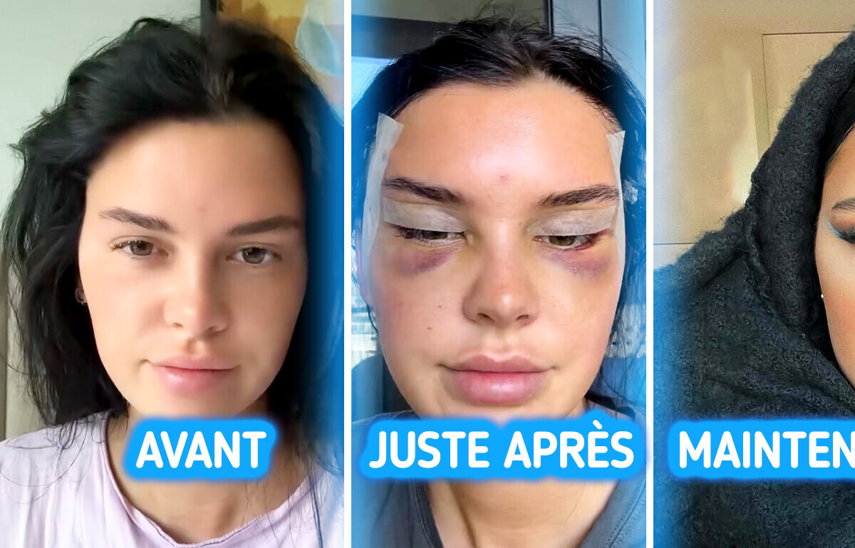 Une jeune femme crée la polémique suite à une opération des yeux Une jeune femme crée la polémique suite à une opération des yeux
