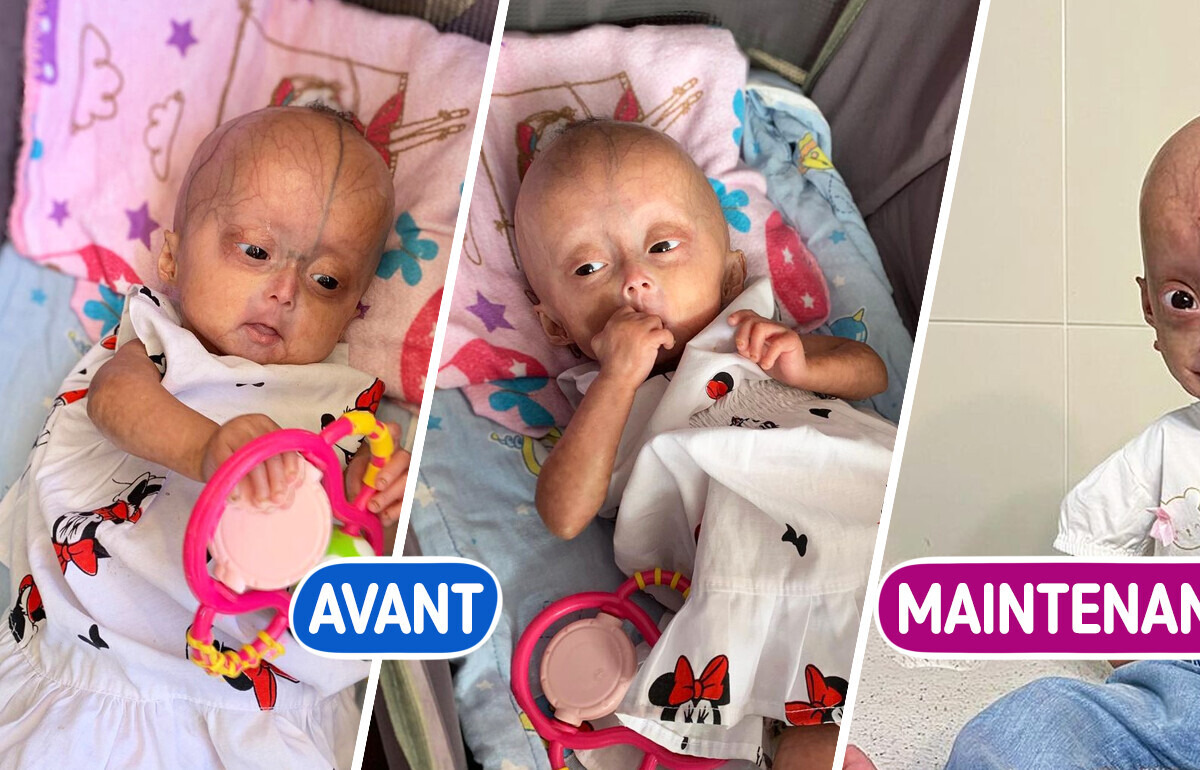 Voici l’histoire étonnante de jumeaux atteints du syndrome de Benjamin Button Voici l’histoire étonnante de jumeaux atteints du syndrome de Benjamin Button