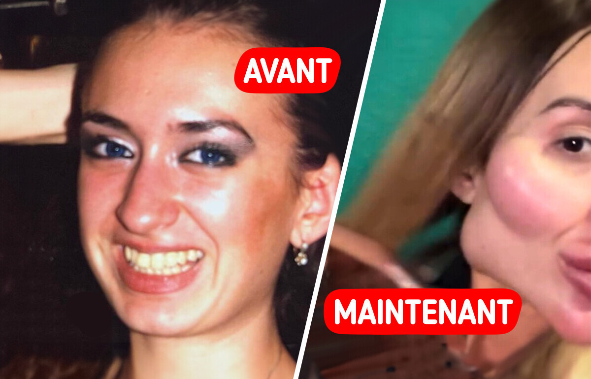 Elle enchaîne les opérations pour avoir "les plus grosses joues du monde", voici le résultat