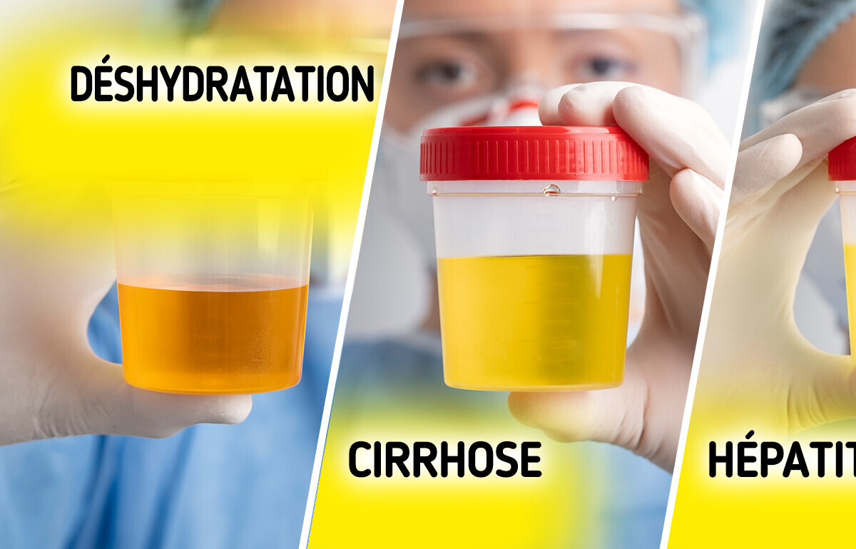 5+ Couleurs d’urine inhabituelles à ne jamais ignorer — et ce qu’elles veulent dire 5+ Couleurs d’urine inhabituelles à ne jamais ignorer — et ce qu’elles veulent dire