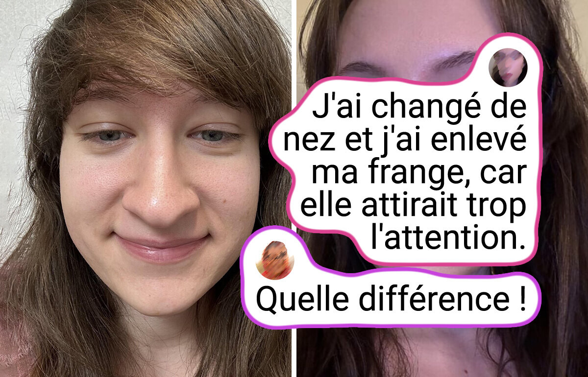 12 Femmes ont révélé comment la chirurgie plastique a changé leur visage