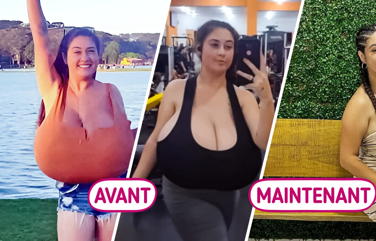 Une jeune femme se fait opérer pour réduire sa poitrine de 10 kilos : le quotidien difficile de la gigantomastie Une jeune femme se fait opérer pour réduire sa poitrine de 10 kilos : le quotidien difficile de la gigantomastie