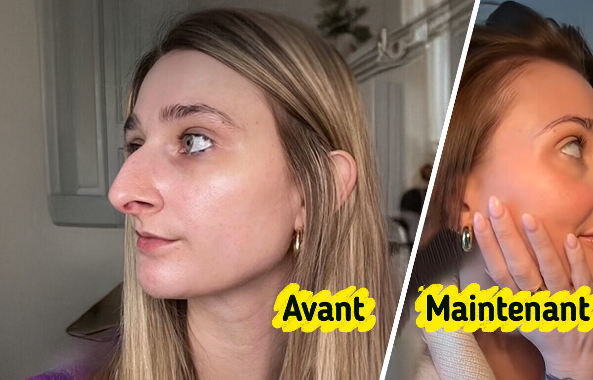 Une femme se fait refaire le nez, et le résultat laisse les internautes sans voix