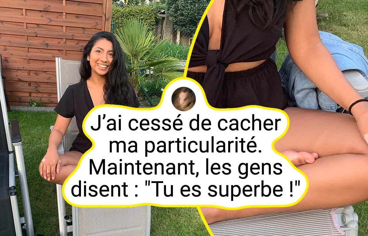 13 Personnes qui ont des particularités physiques impossibles à reproduire