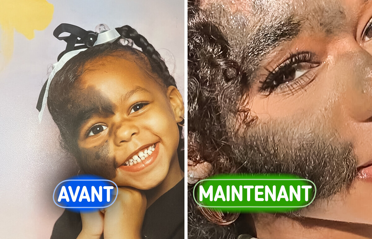 Elle vit avec le "syndrome du loup-garou" et sa beauté unique met tout le monde d’accord