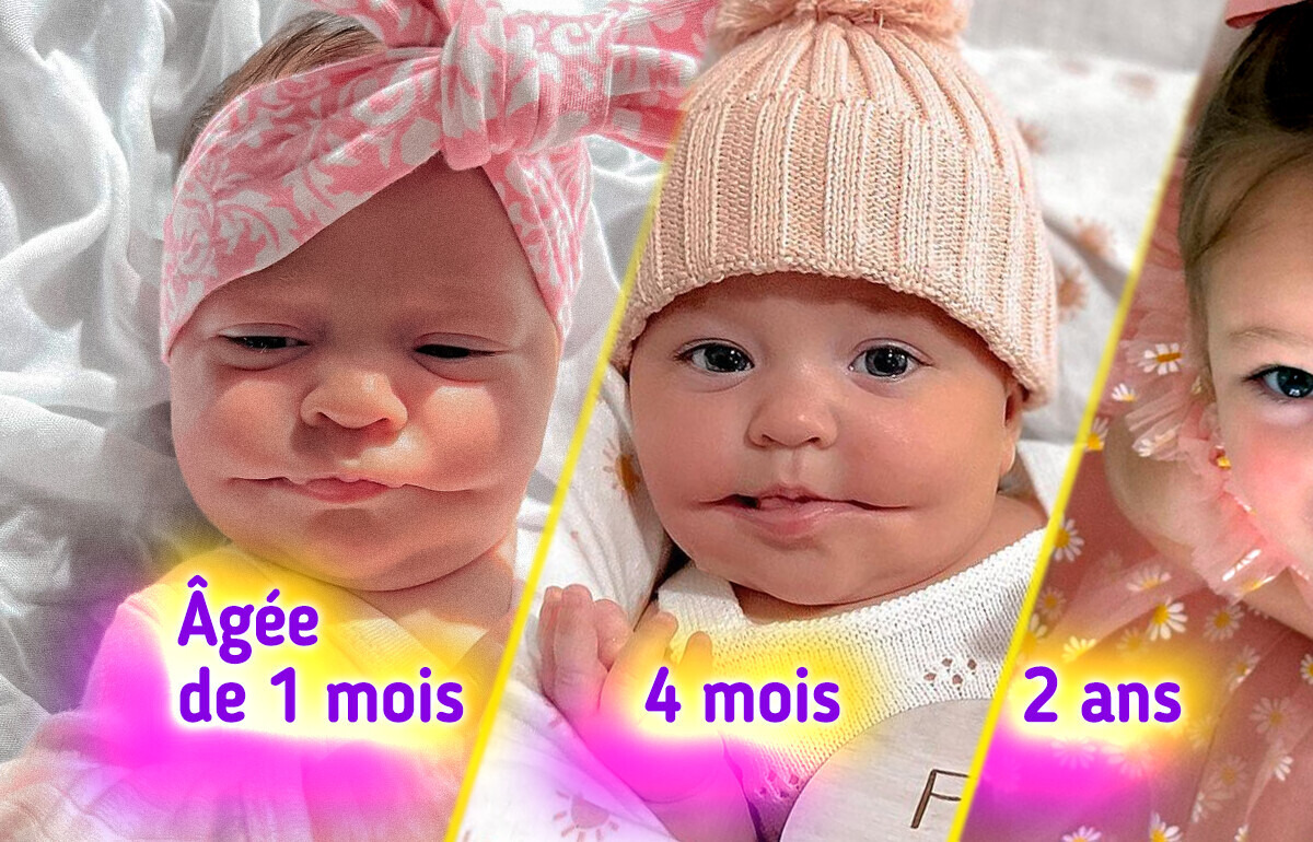 Née avec un sourire permanent, cette fille fait partie des 14 cas uniques dans le monde Née avec un sourire permanent, cette fille fait partie des 14 cas uniques dans le monde