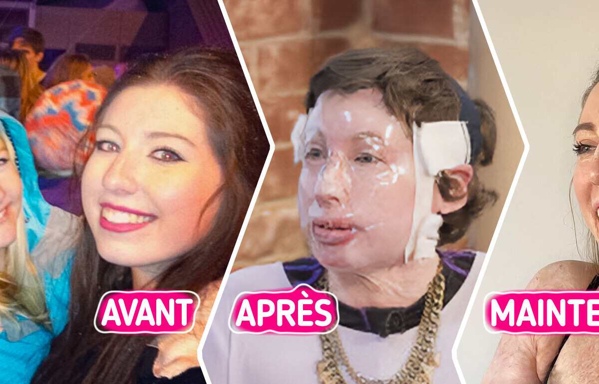 Cette femme brûlée à 96% n'est pas complexée par son physique et se montre en maillot de bain