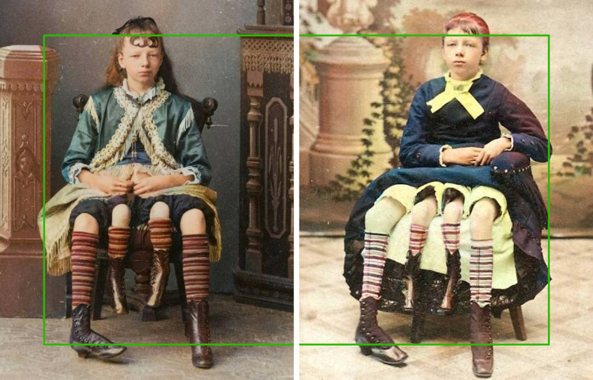 Née avec quatre jambes, elle a prouvé qu’une différence pouvait devenir une force