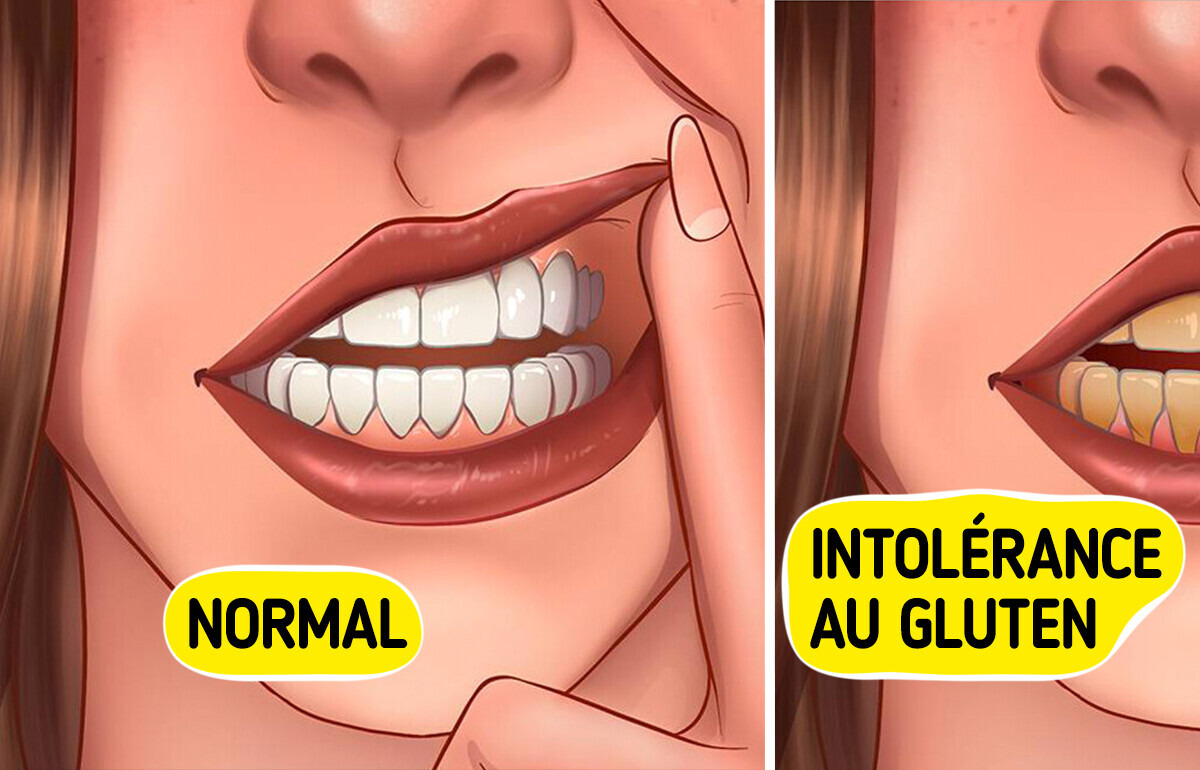 11 Signes d’intolérance au gluten que les gens ont tendance à négliger