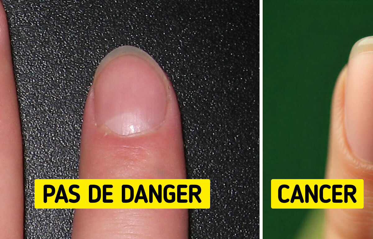 Une mère de quatre enfants repère une marque inhabituelle sur un ongle, et elle n'était pas sans danger