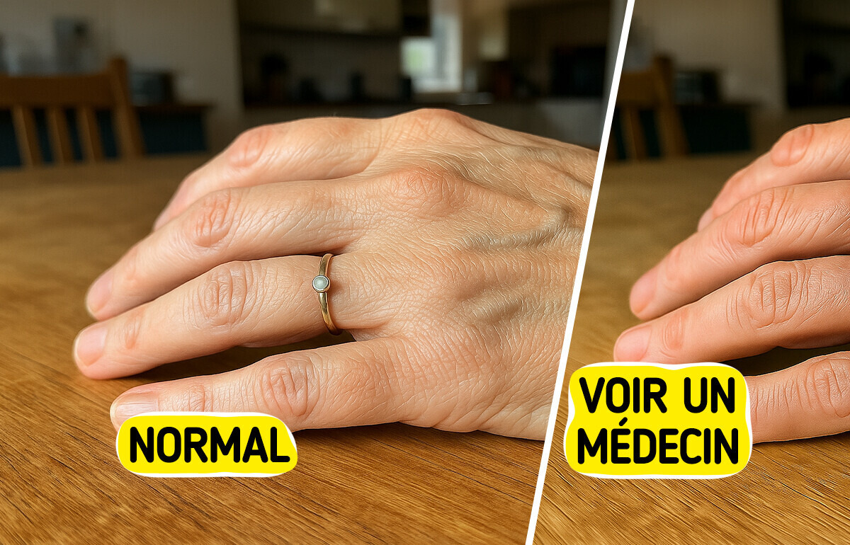 8 Causes courantes de veines apparentes — et les signes à ne pas ignorer 8 Causes courantes de veines apparentes — et les signes à ne pas ignorer